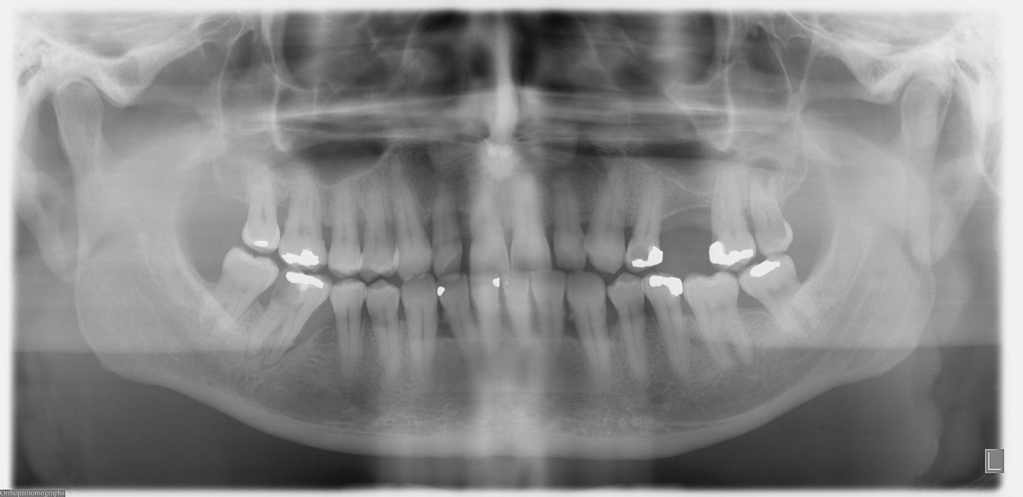 Abscess Tooth Orthopantomogram